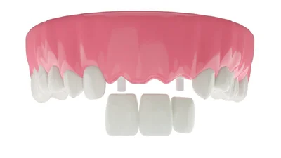 Should I Get Crowns on My Front Teeth?