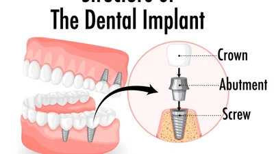 What is an Abutment in Dentistry? Role & Impacts