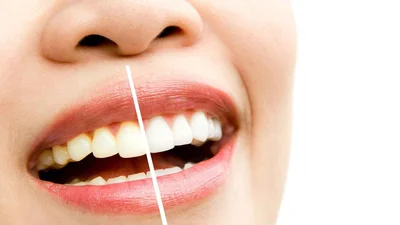 Can Yellow Teeth Become White Again?